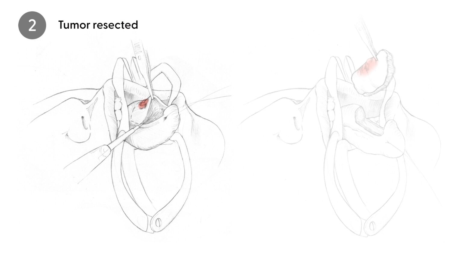 Tumor Resection