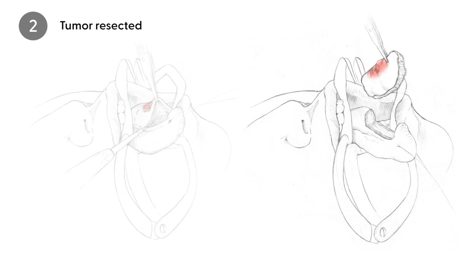 Tumor Resection
