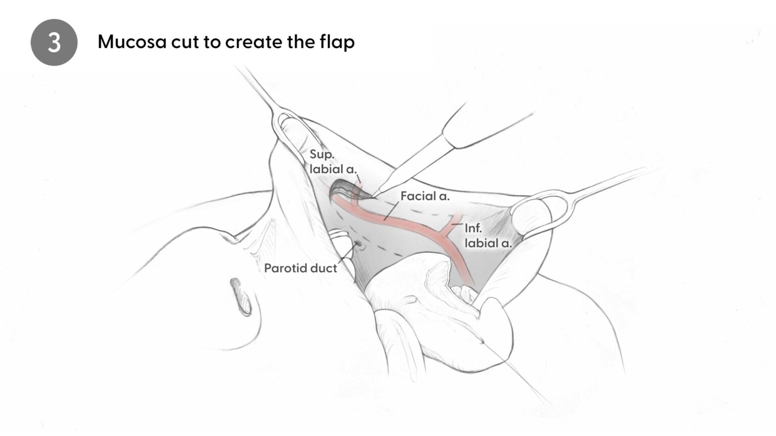 Beginning of mucosal cut