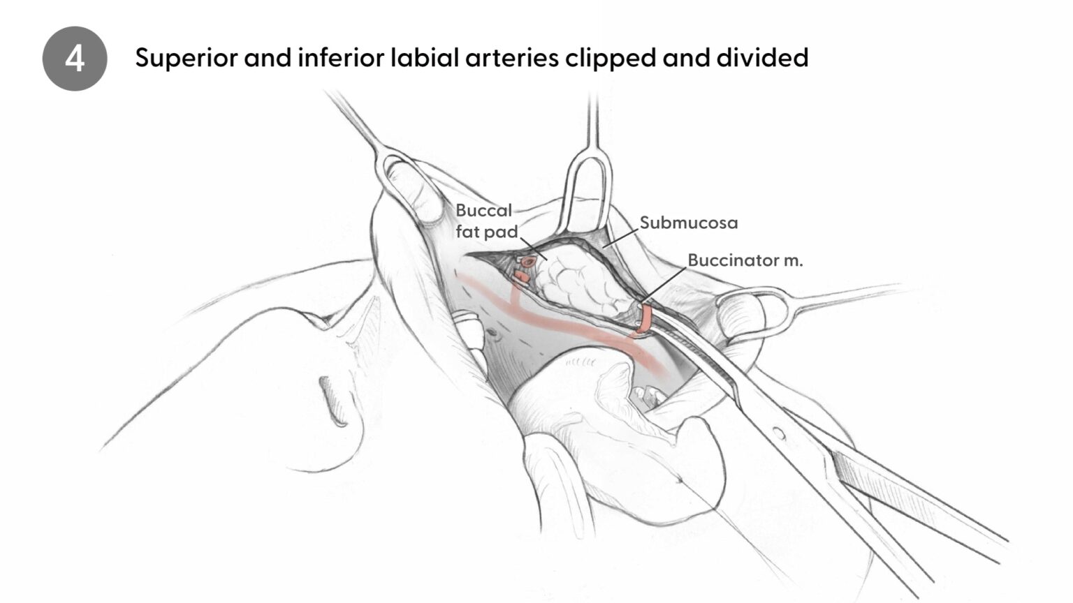 Superior and inferior labial arteries divided