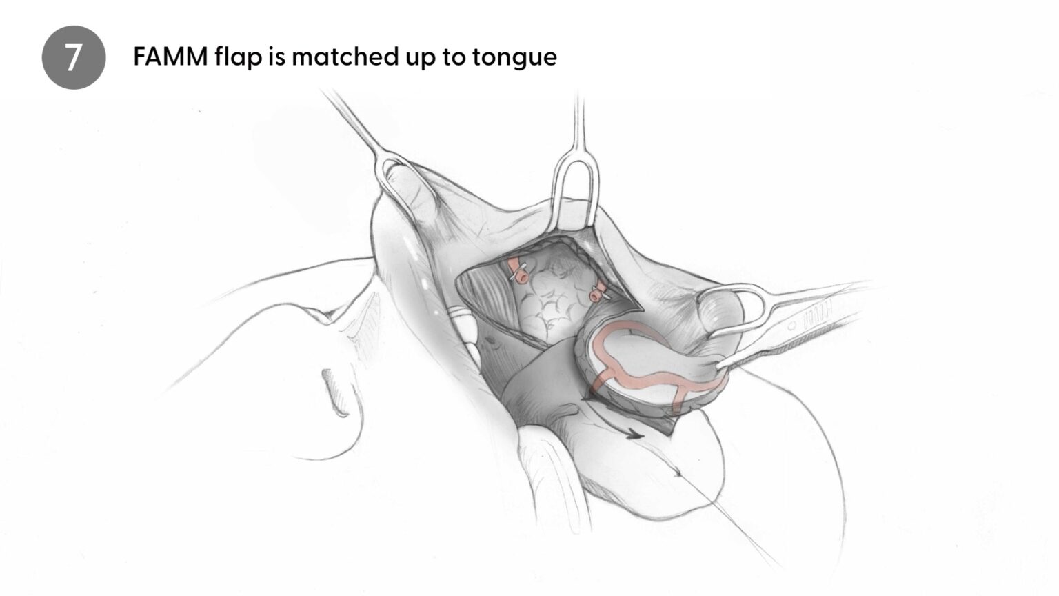 FAMM Flap is matched to tongue