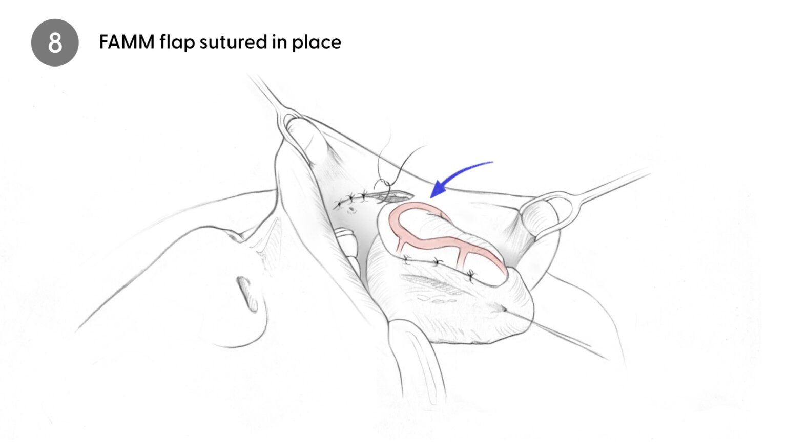 FAMM Flap is sutured
