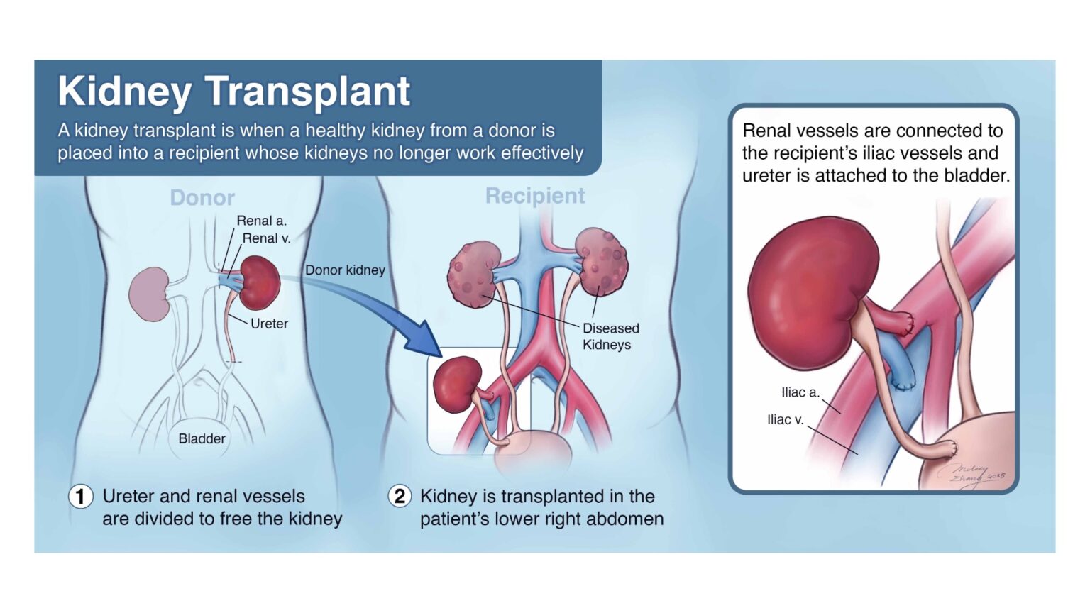 Kidney transplant patient education