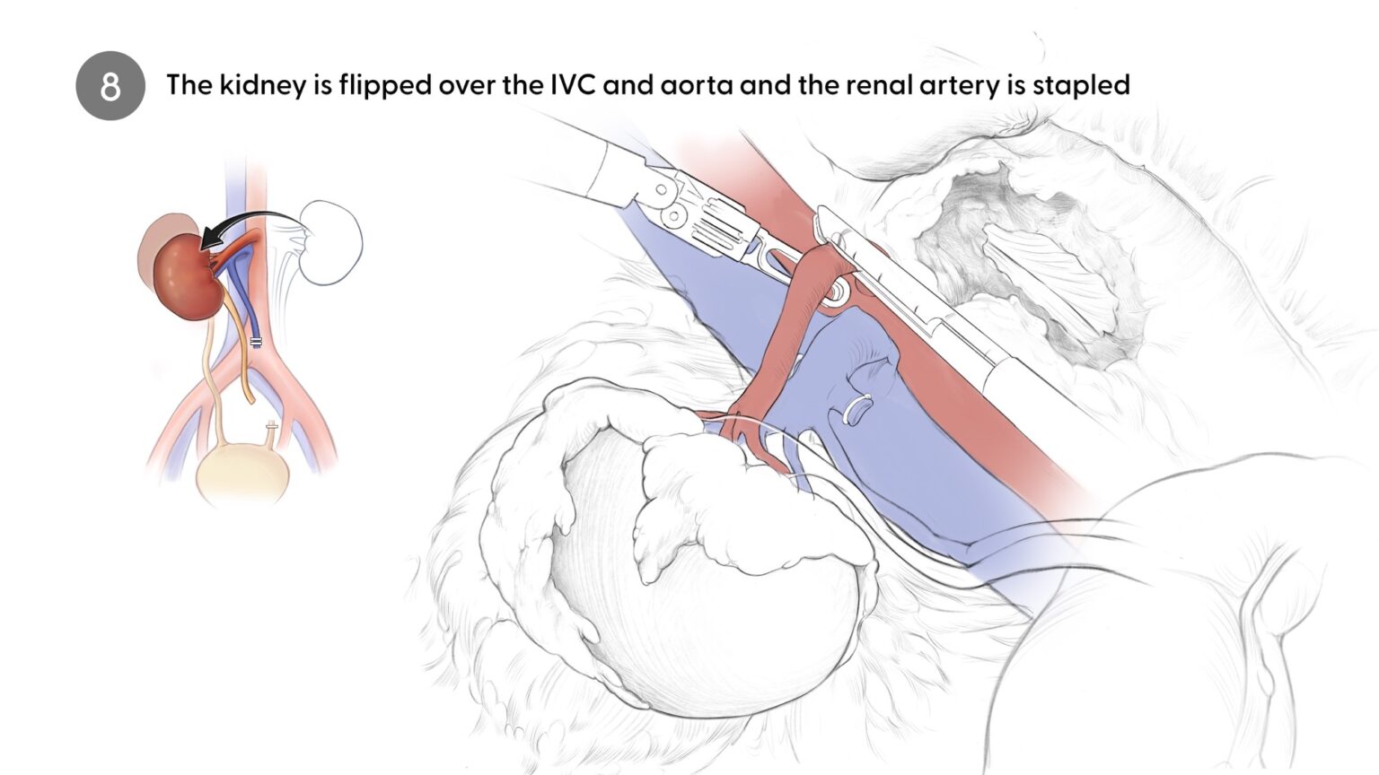 Stapling renal artery
