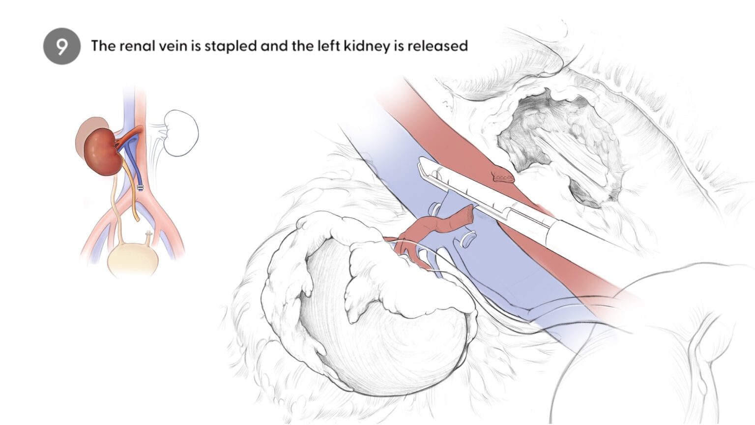 Stapling renal vein