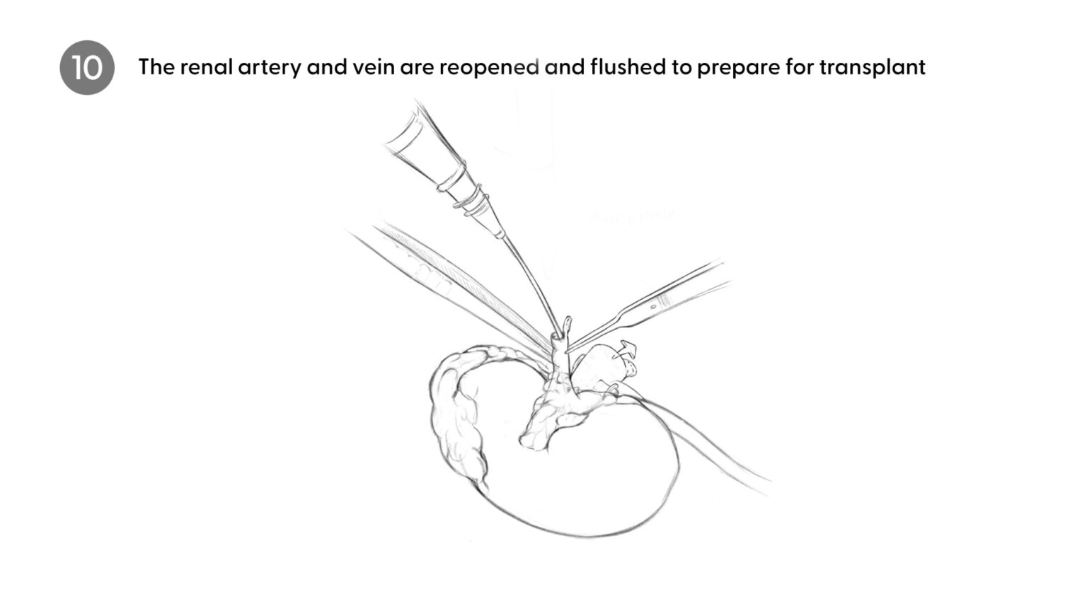 Flushing kidney