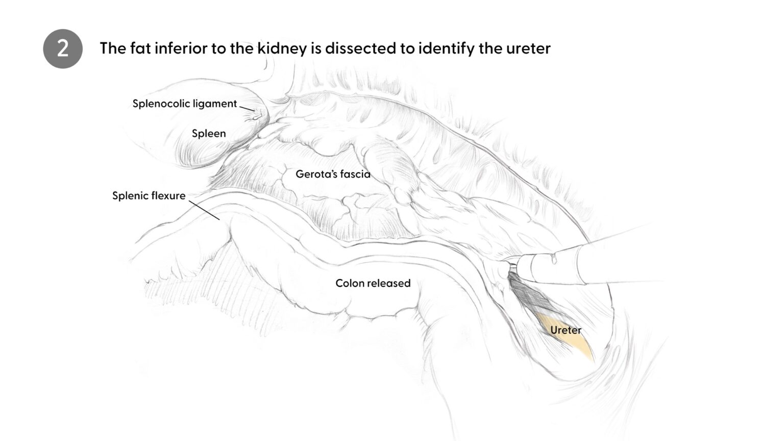 Locating the Ureter