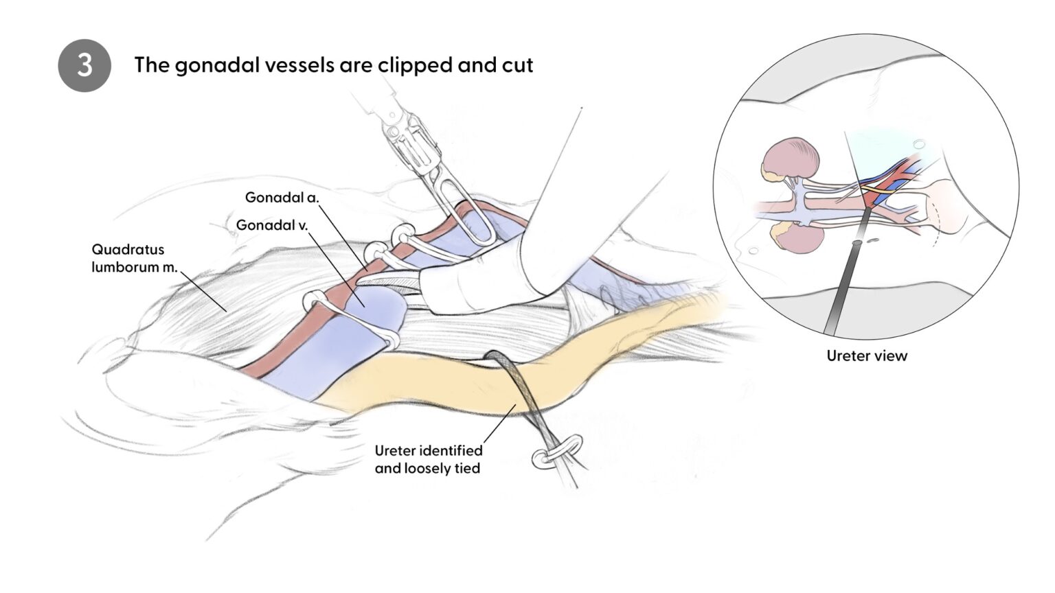 Clipping gonadal vessels