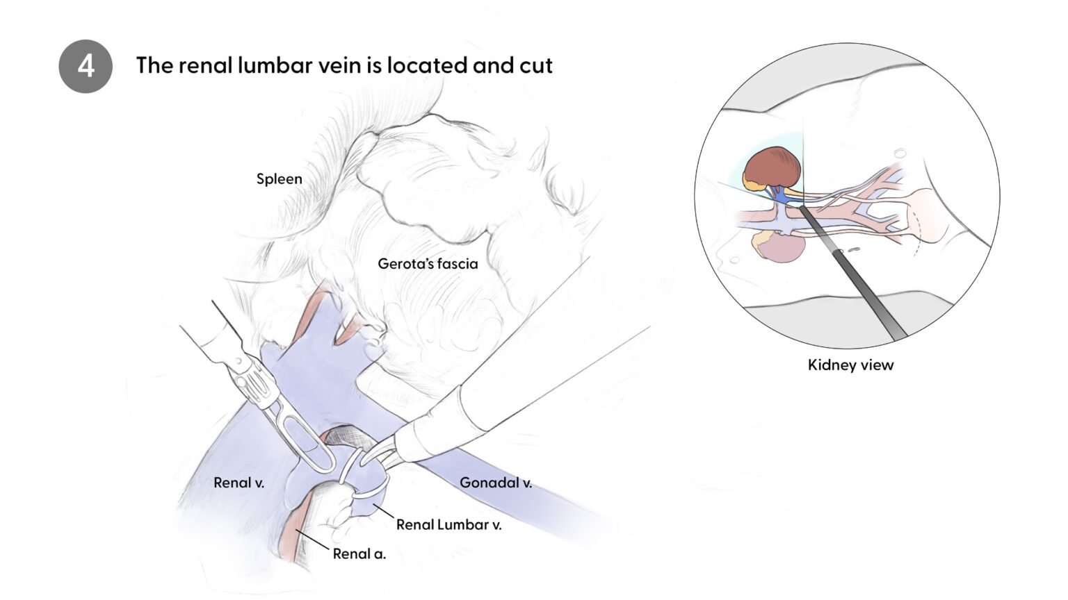Clipping lumbar vein