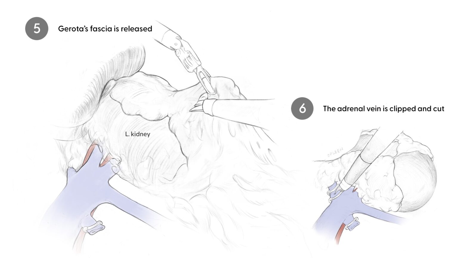 Releasing Gerota's fascia and clipping adrenal vein