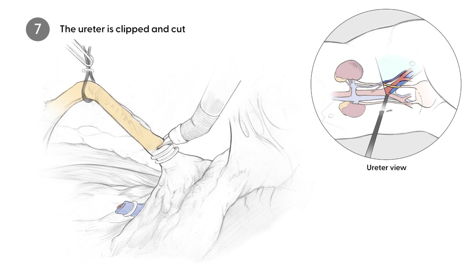 Clipping ureter